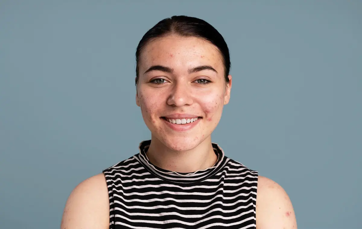 acne and pimple treatment