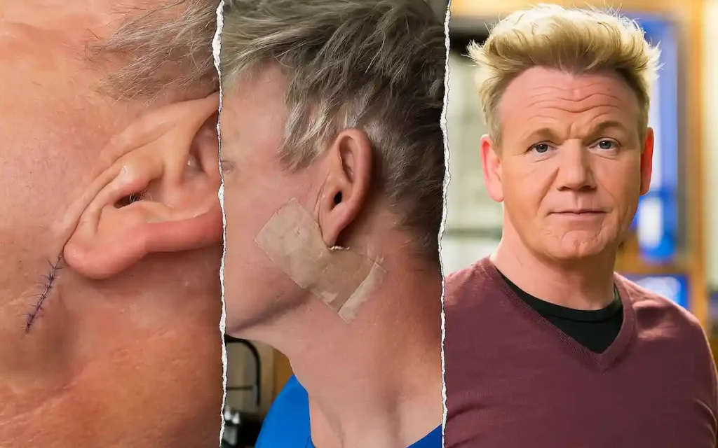 Shocking Health Update: Gordon Ramsay Skin Cancer Surgery After Bike Accident